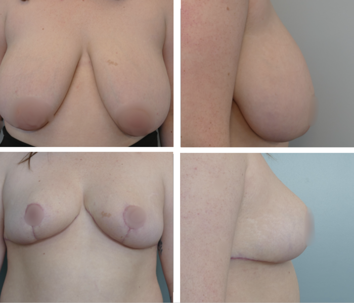 Breast reduction before and after